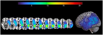 Investigating silent pauses in connected speech: integrating linguistic, neuropsychological, and neuroanatomical perspectives across narrative tasks in post-stroke aphasia